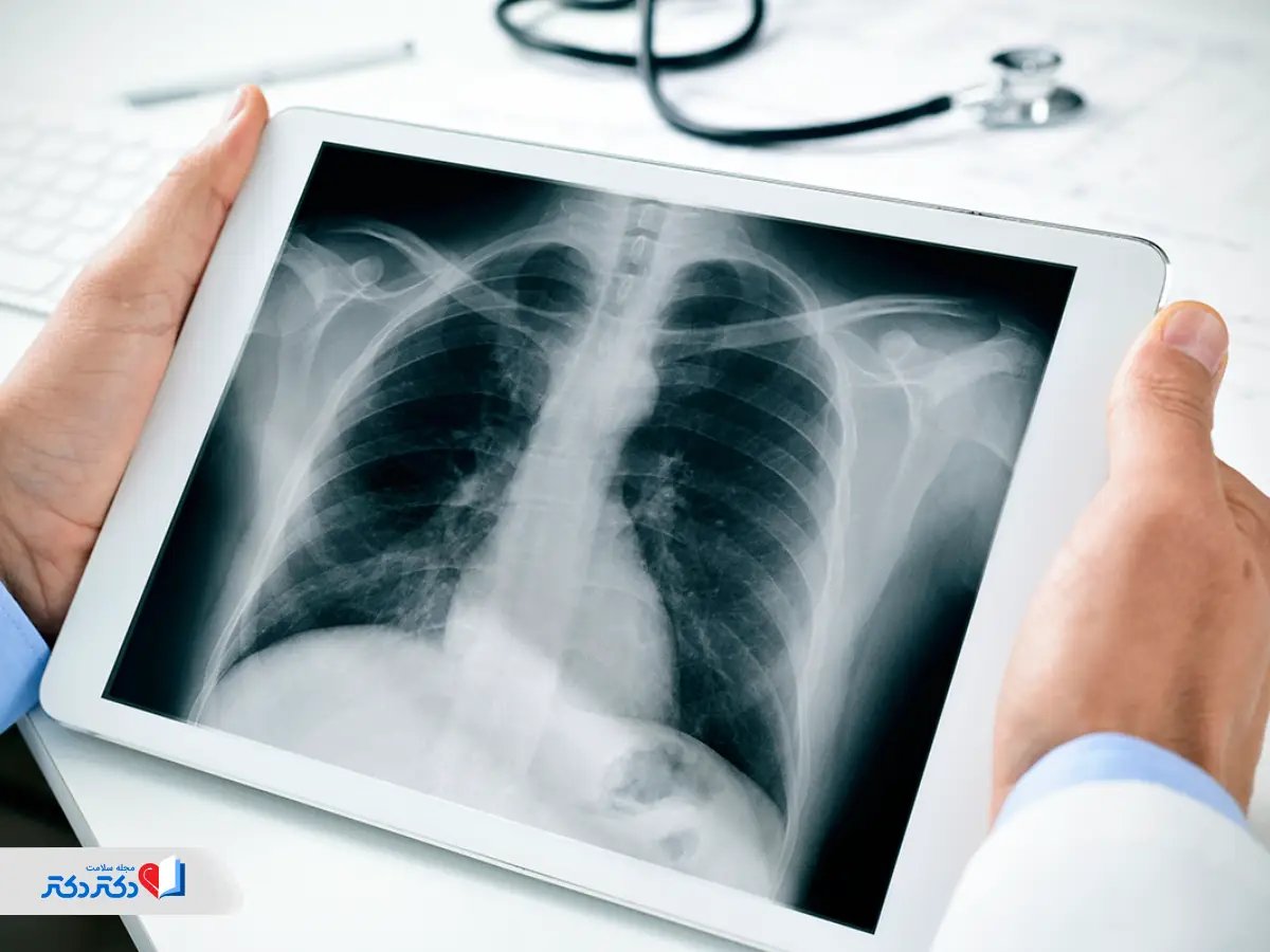 انواع فیبروز ریه