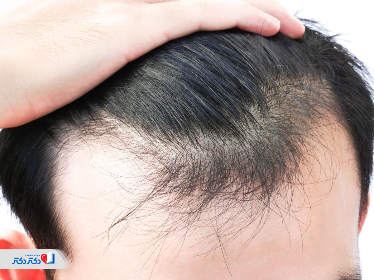 استرس اکسیداتیو و ریزش مو