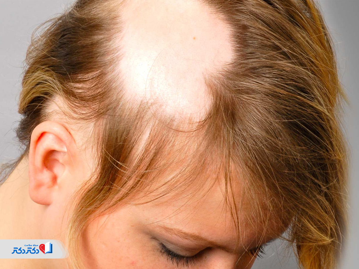 ریزش موی منطقهای (آلوپسی آرهآتا)