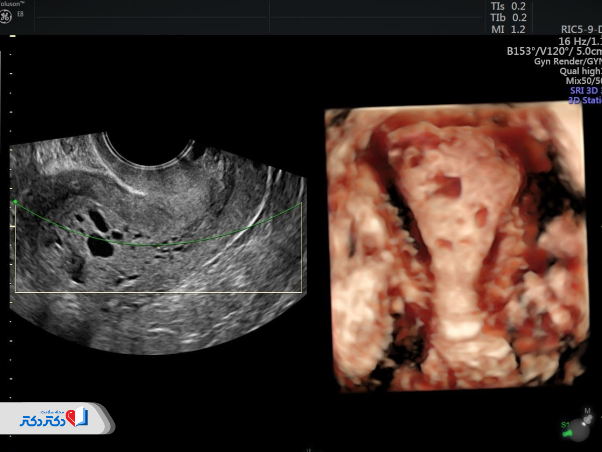 روش های تشخیص سرطان رحم