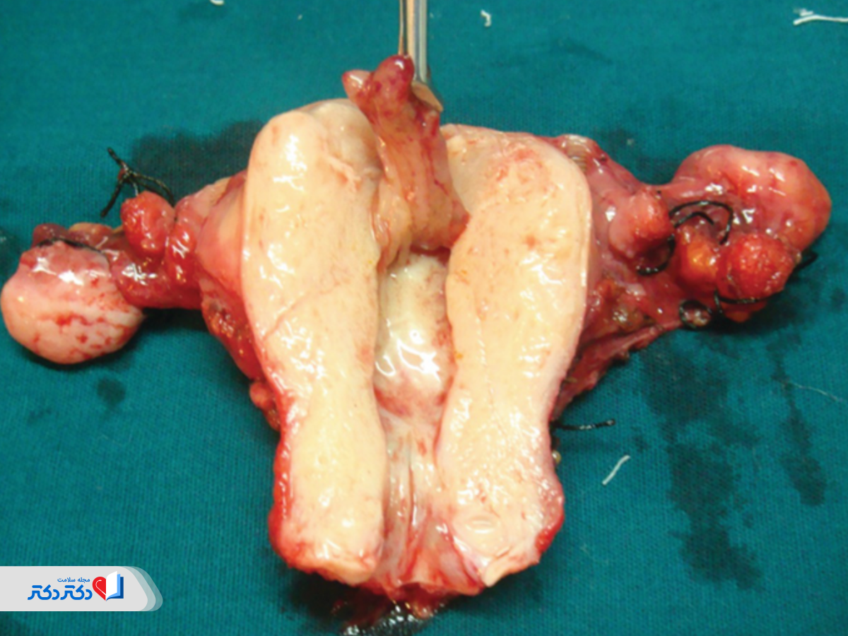 روش های درمان سرطان رحم