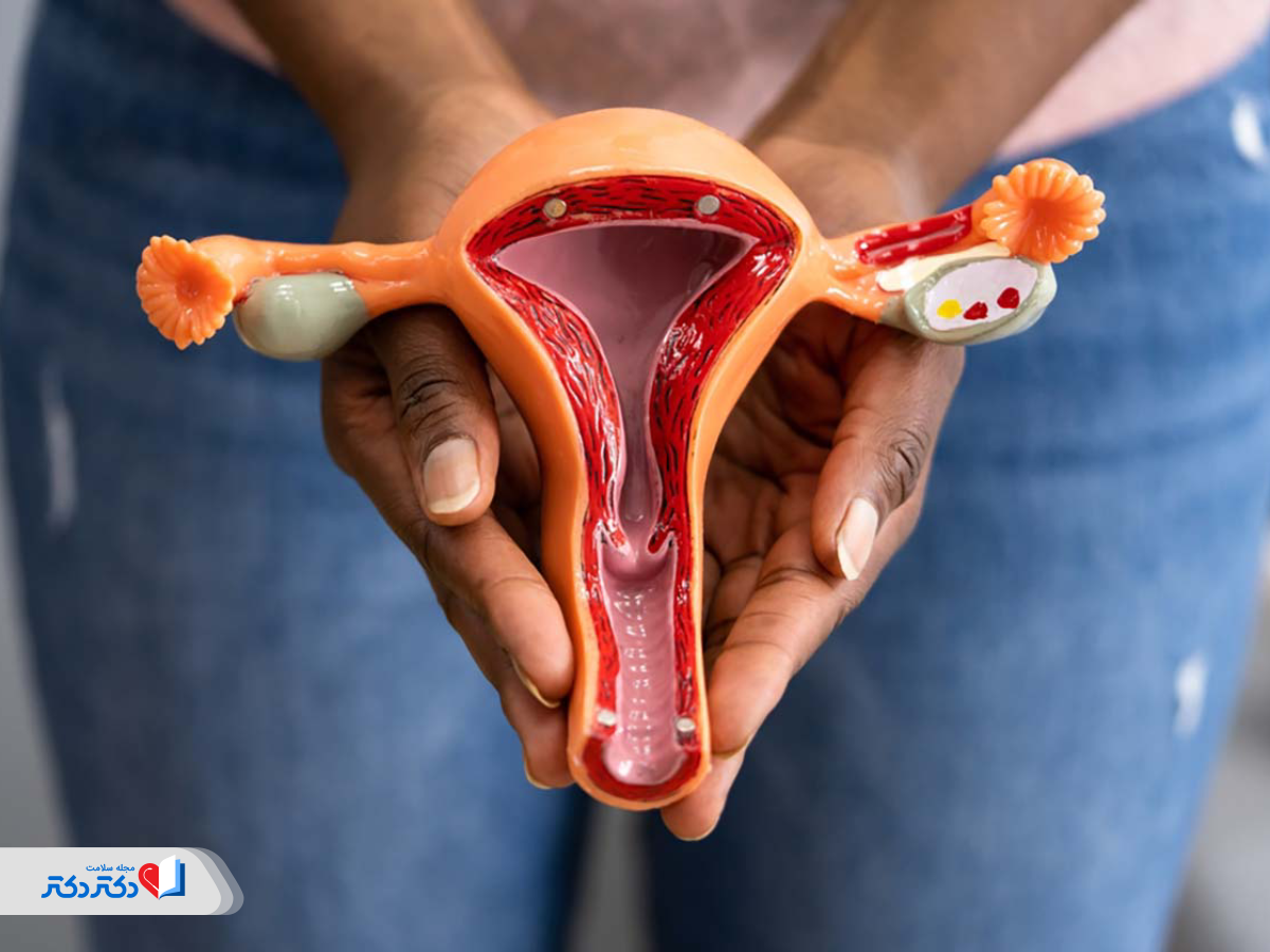 متاستاز سرطان رحم