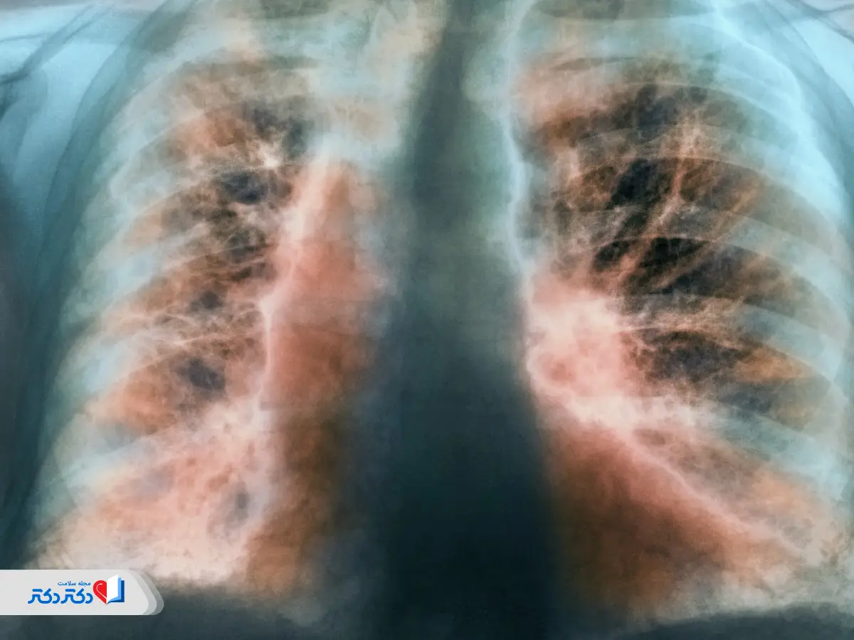 انواع فیبروز ریه