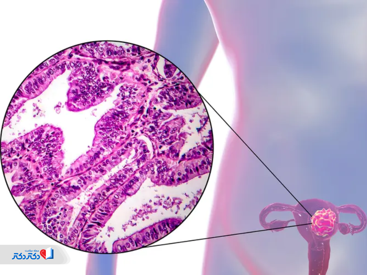 علائم متاستاز سرطان رحم