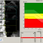 آزمایش تراکم استخوان؛ تشخیص زودهنگام پوکی استخوان