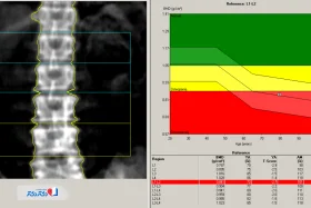 آزمایش تراکم استخوان؛ تشخیص زودهنگام پوکی استخوان