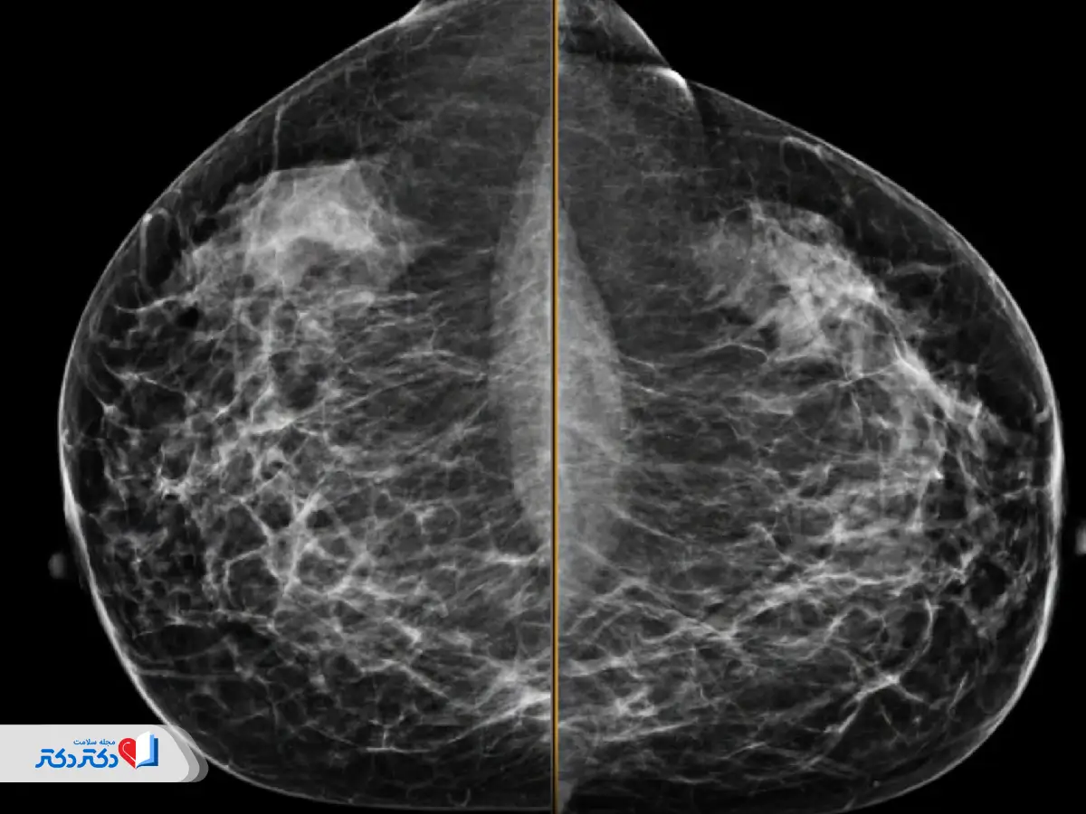 عکس ماموگرافی نرمال