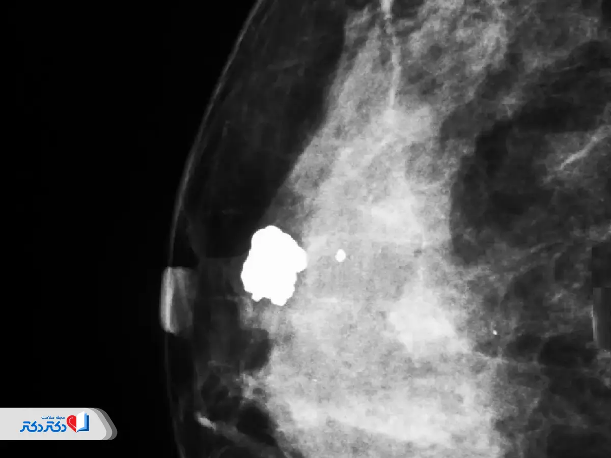 فیبروآدنوما توده‌ای جامد و خوش‌خیم در ماموگرافی