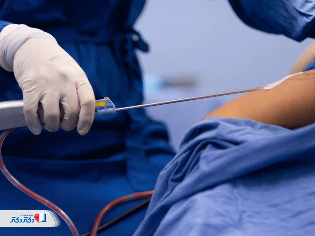 تفاوت کول اسکالپتینگ با لیپوساکشن