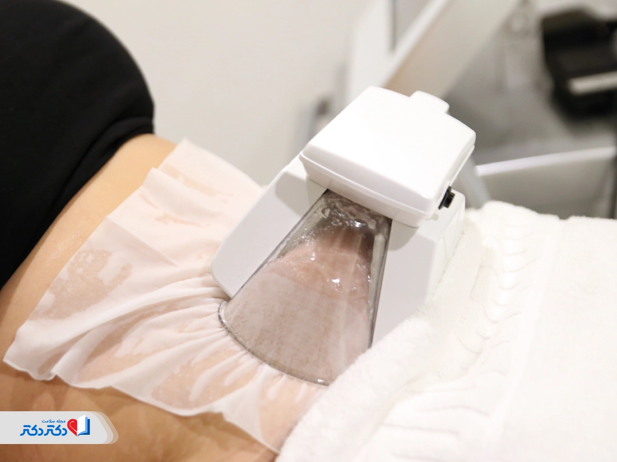 کاهش چربی شکم با کول اسکالپتینگ 