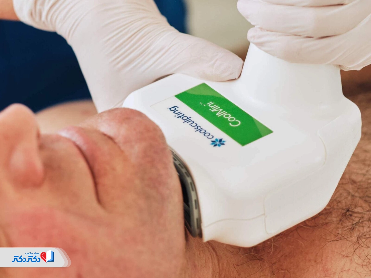 ازبین‌بردن غبغب با کاهش چربی زیر چانه با کول اسکالپتینگ 