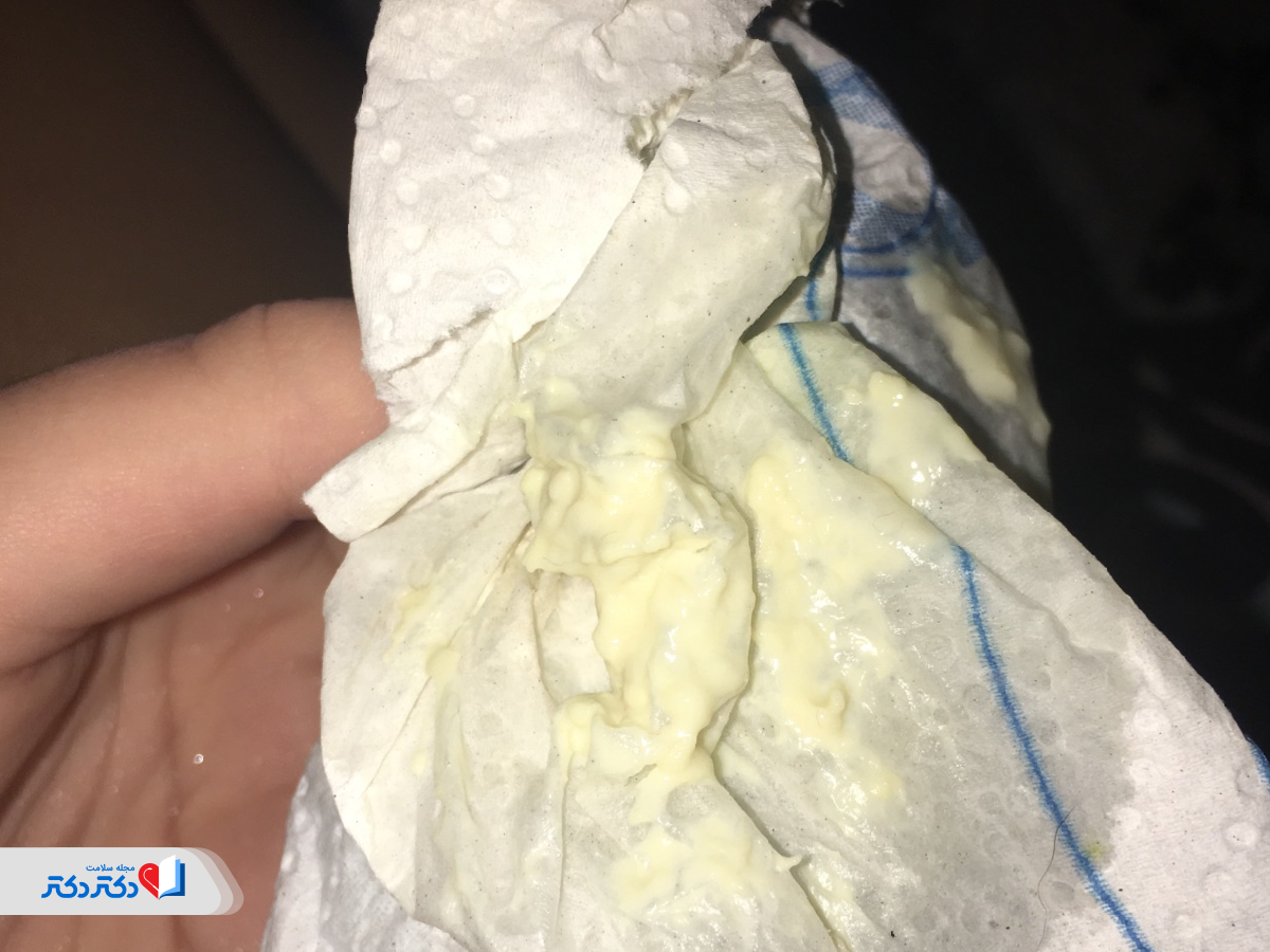 علت ترشحات پنیری واژن