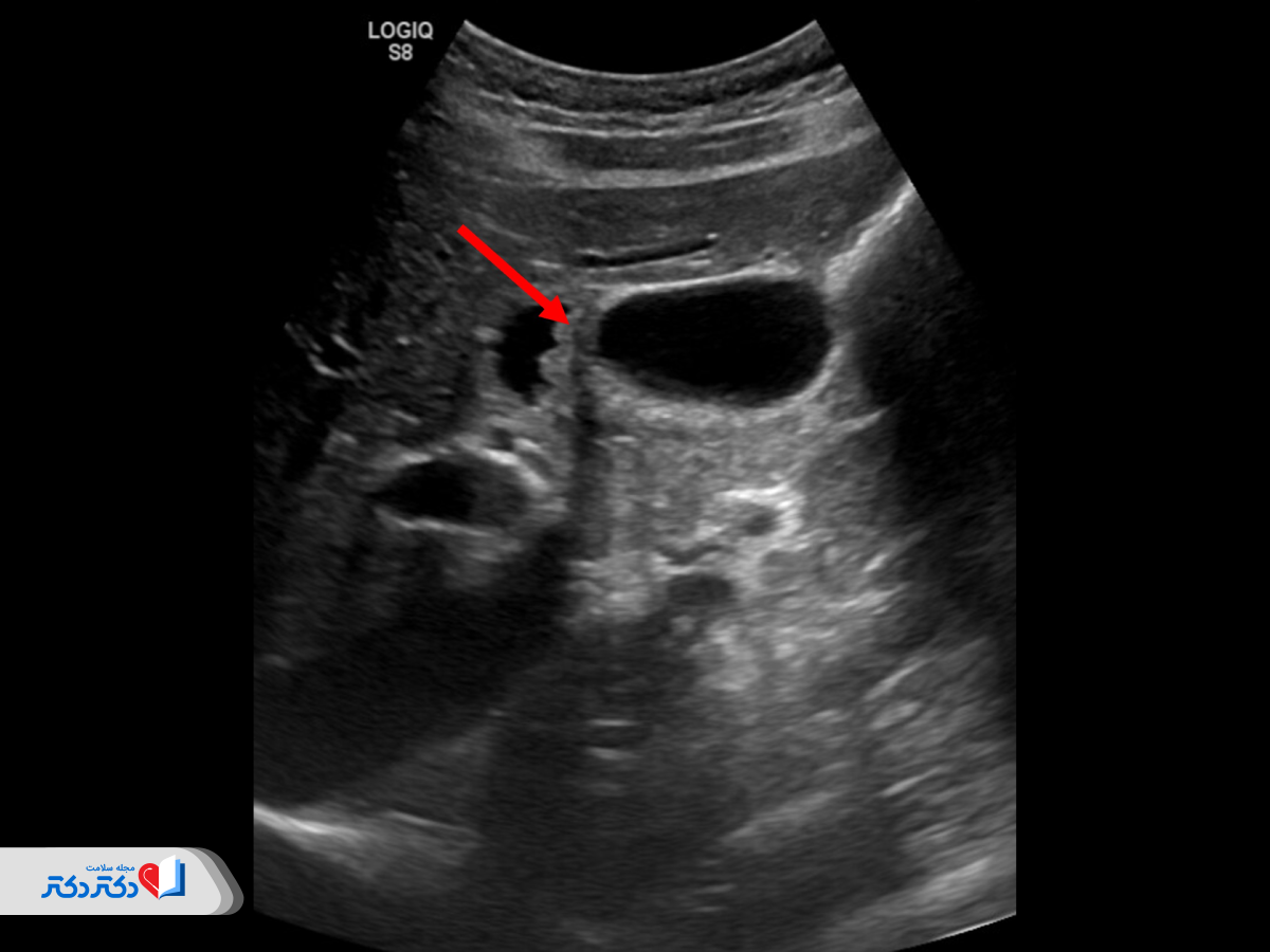 تفسیر نتایج سونوگرافی شکم چگونه است؟