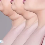 لیپوساکشن غبغب: روش‌ها، مزایا، عوارض و مراقبت‌ها