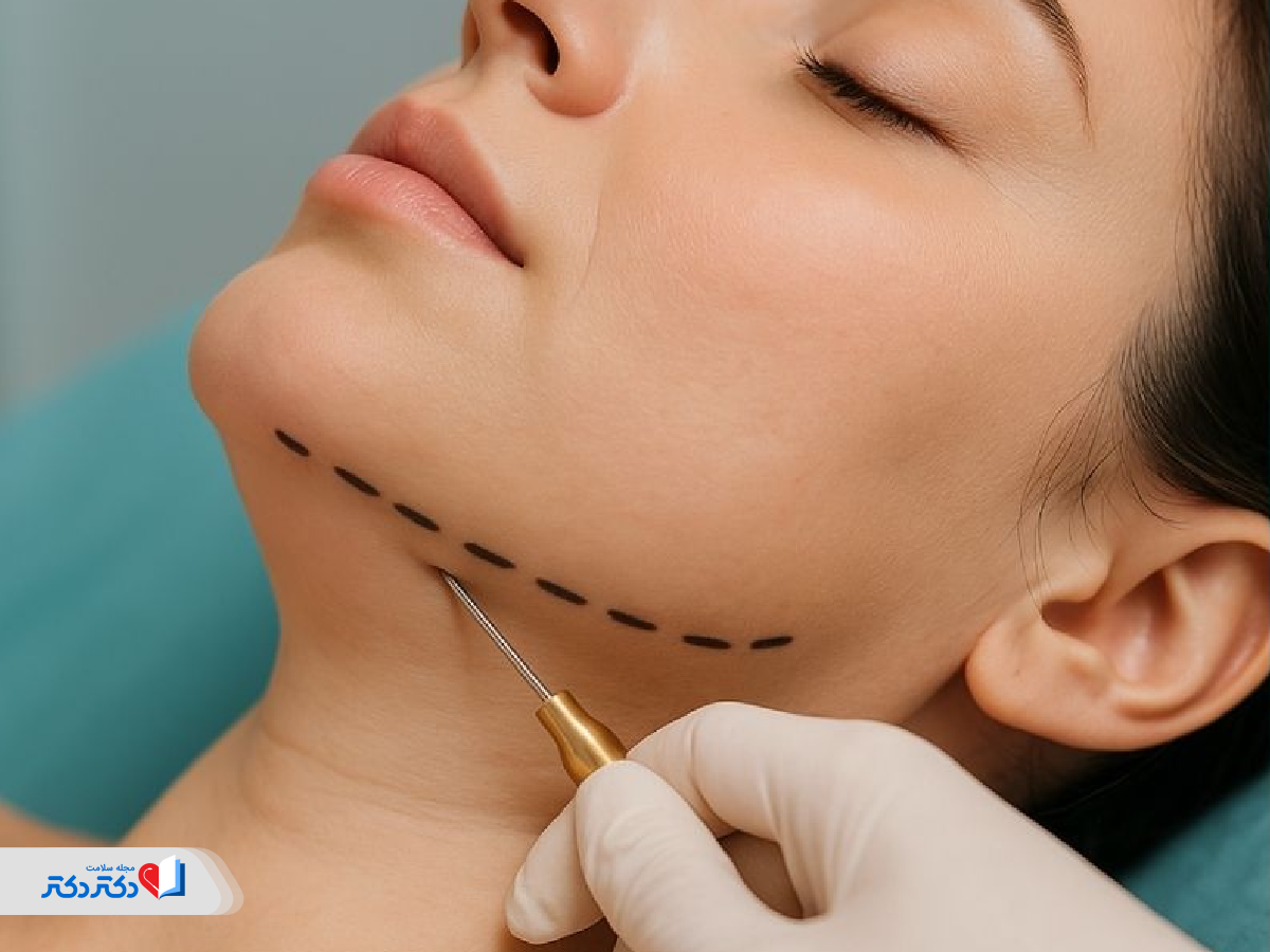 عوارض و خطرات احتمالی لیپوساکشن غبغب