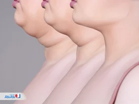 لیپوساکشن غبغب: روش‌ها، مزایا، عوارض و مراقبت‌ها
