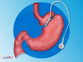 حلقه معده چیست؟ آشنایی با مزایا، عوارض و هزینههای آن