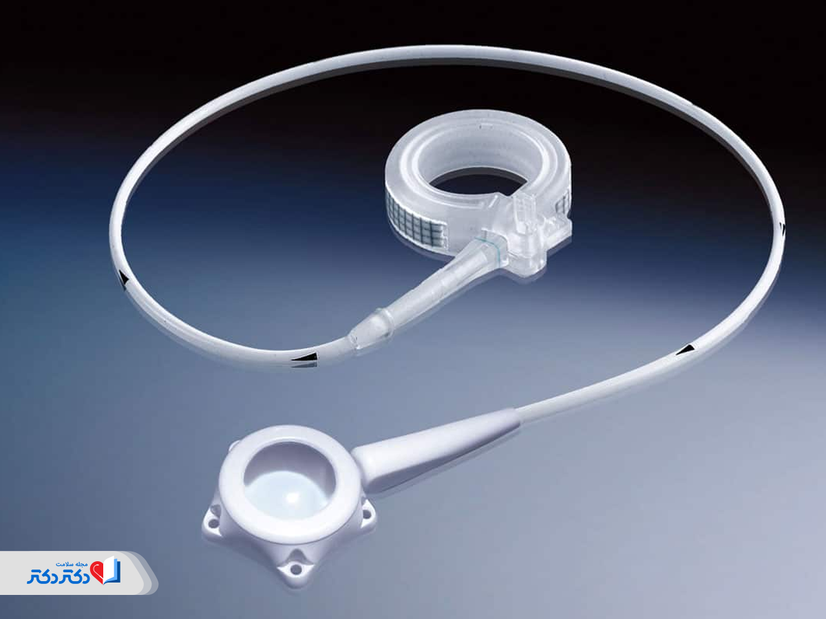 بند معده راهی ایمن، موثر و فوری برای کاهش وزن است