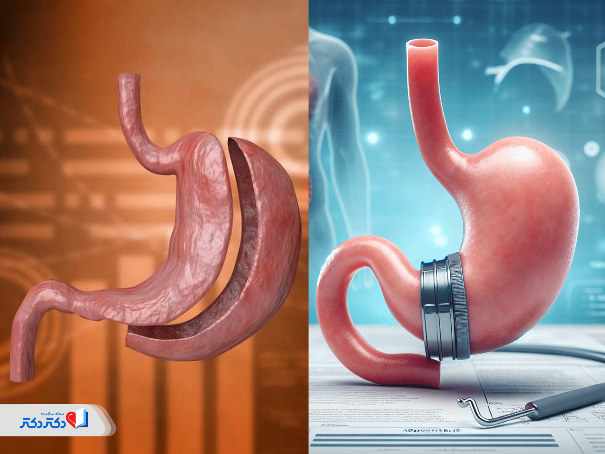 تفاوت جراحی اسلیو و باند معده