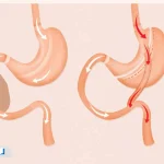 عمل بای پس معده: همه چیز درباره عمل، فواید و مراقبت‌ها