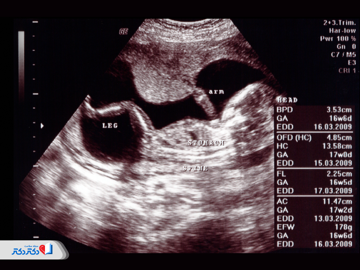 معنی اصطلاحات سونوگرافی آنومالی و تفسیر آن
