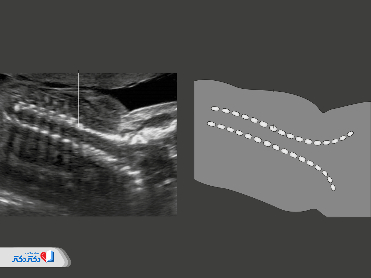 بررسی ستون‌ فقرات در سونوگرافی آنومالی
