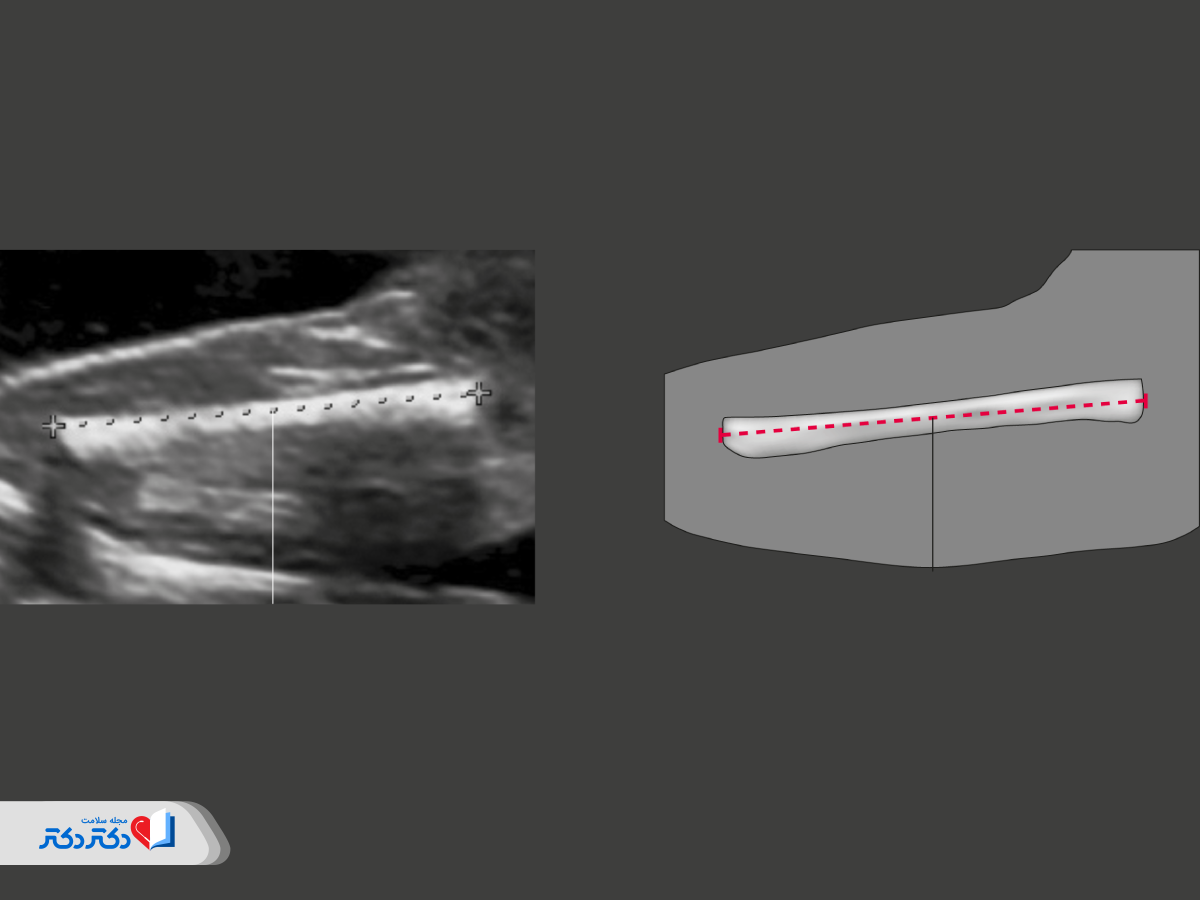 بررسی طول استخوان ران در سونوگرافی آنومالی