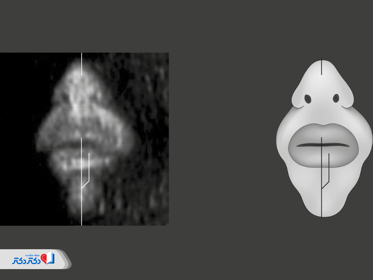 بررسی صورت در سونوگرافی آنومالی