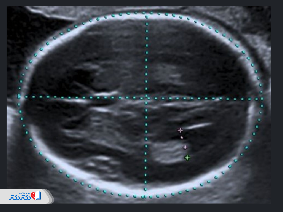 بررسی مغز و جمجمه سونوگرافی آنومالی اسکن