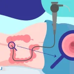 کاربرد کولونوسکوپی در تشخیص پولیپ و سرطان روده بزرگ