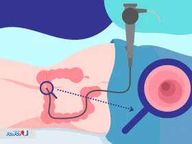 کاربرد کولونوسکوپی در تشخیص پولیپ و سرطان روده بزرگ