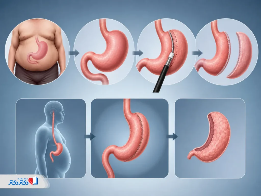 عکس عمل اسلیو معده شامل تغییرات معده در قبل و بعد عمل اسلیو معده