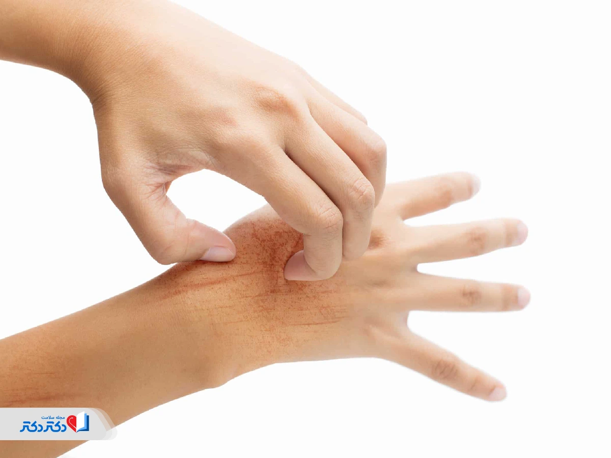 مشکلات پوستی از بیماری‌های سایکوسوماتیک چيست
