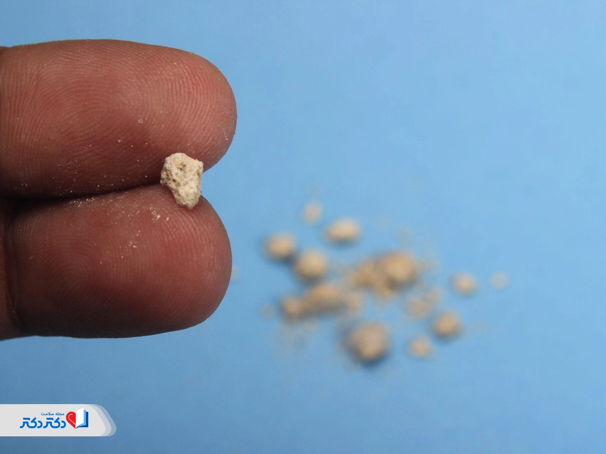 آنالیز سنگ دفع‌شده