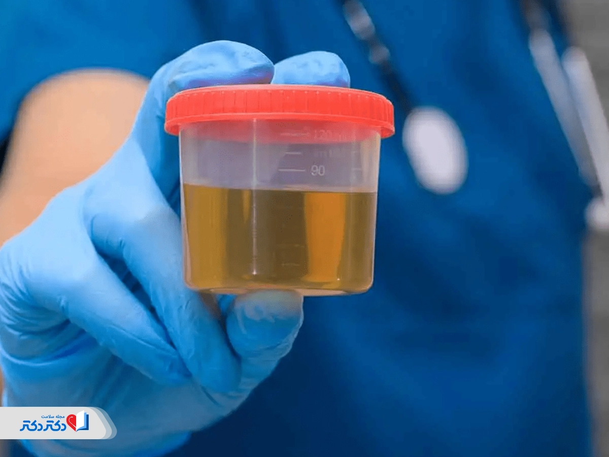 آزمایش ادرار برای سنگ کلیه