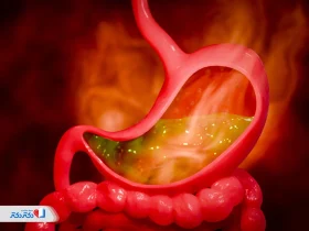 کاهش اسید معده: راهکارهای فوری، رژیم غذایی و درمان خانگی رفلاکس معده در بارداری