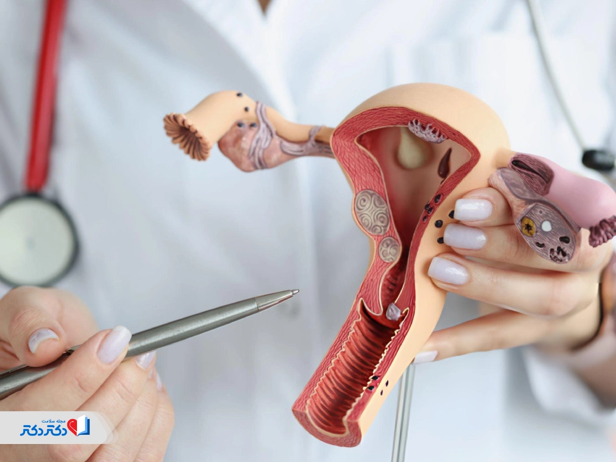 آناتومی رحم با توده‌های سرطان دهانه رحم