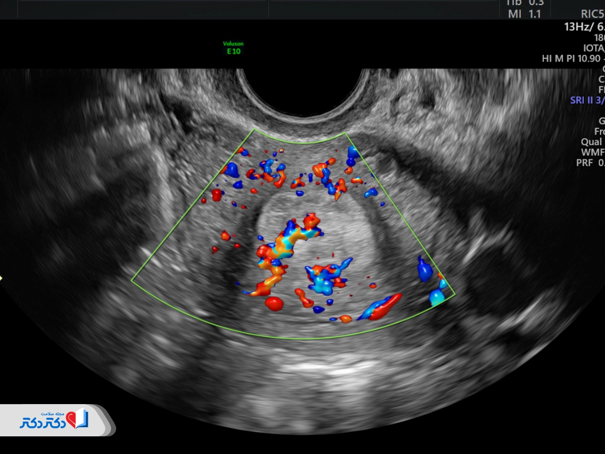 سونوگرافی داپلر رنگی