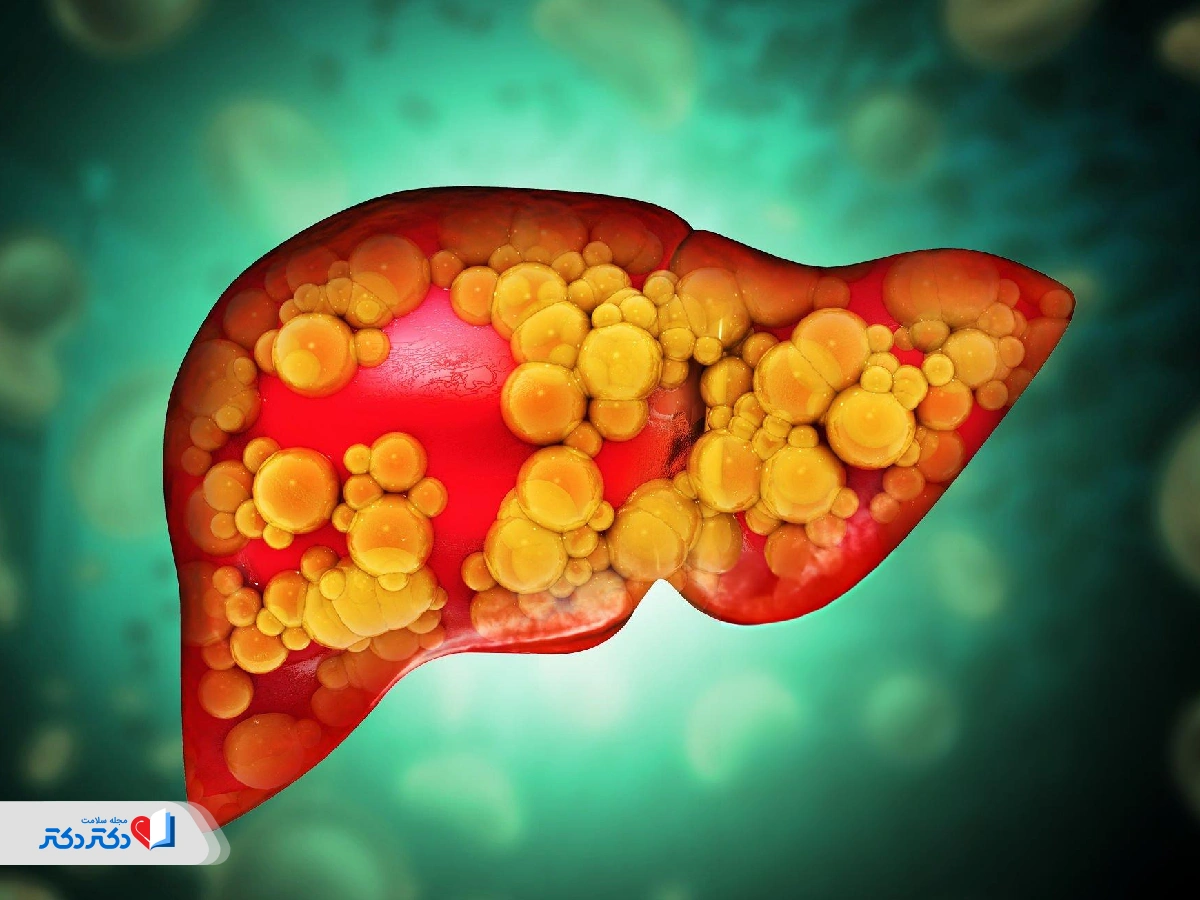 درجه‌بندی کبد چرب