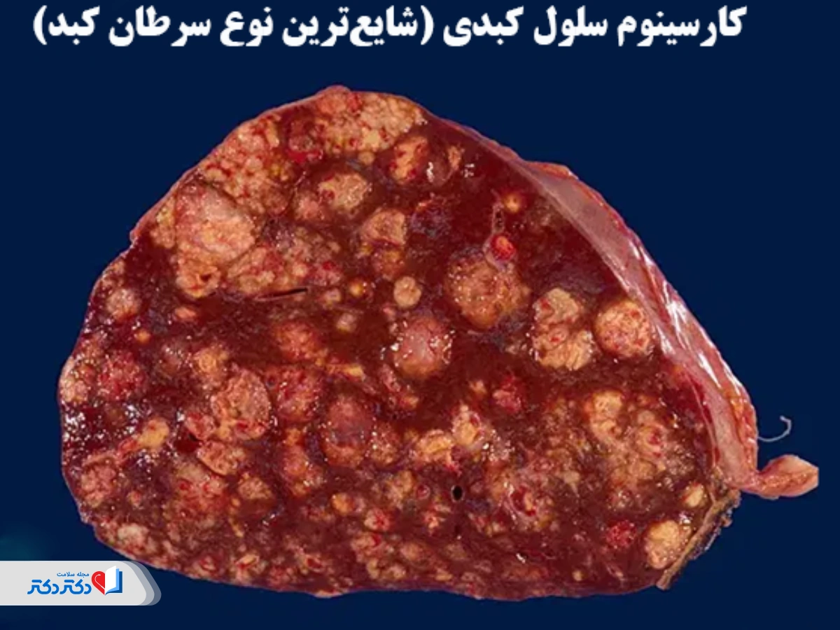 خطر کبد چرب گرید ۲