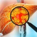 آزمایش کبد چرب چیست و چه مشکلاتی را در بدن مشخص می‌کند؟