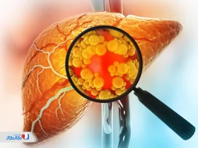 آزمایش کبد چرب چیست و چه مشکلاتی را در بدن مشخص می‌کند؟