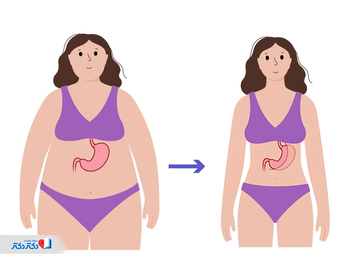کوچککردن معده در عمل اسلیو معده