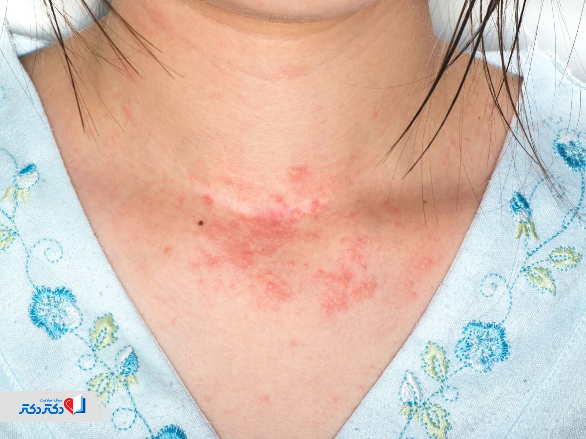 عوارض پودر لاغری طلای سبز