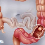 علائم انسداد روده در کودکان، نوزادان و بزرگسالان