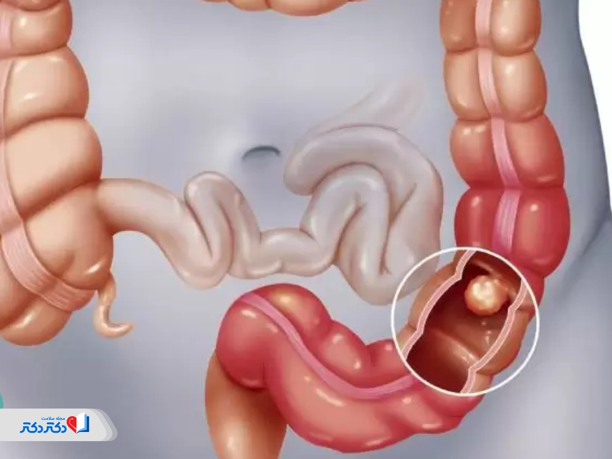 علائم انسداد روده کودکان و بزرگسالان