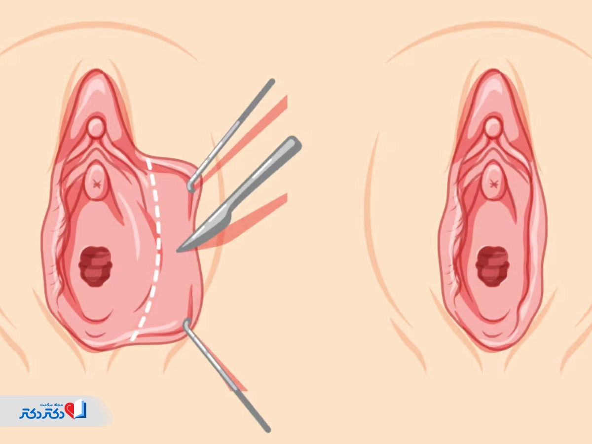 مراقبت‌های بعد از لابیاپلاستی