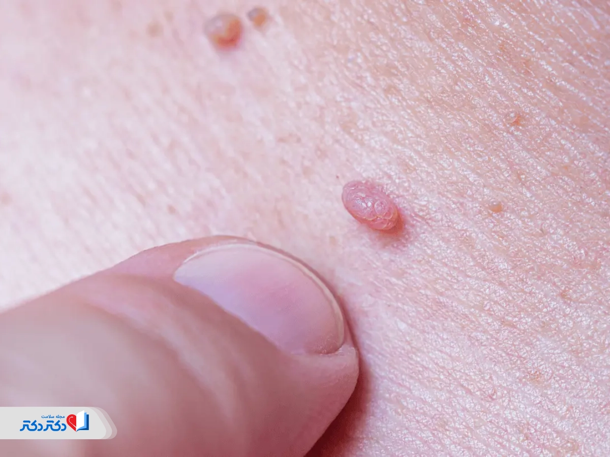 علائم زگیل تناسلی کم‌خطر