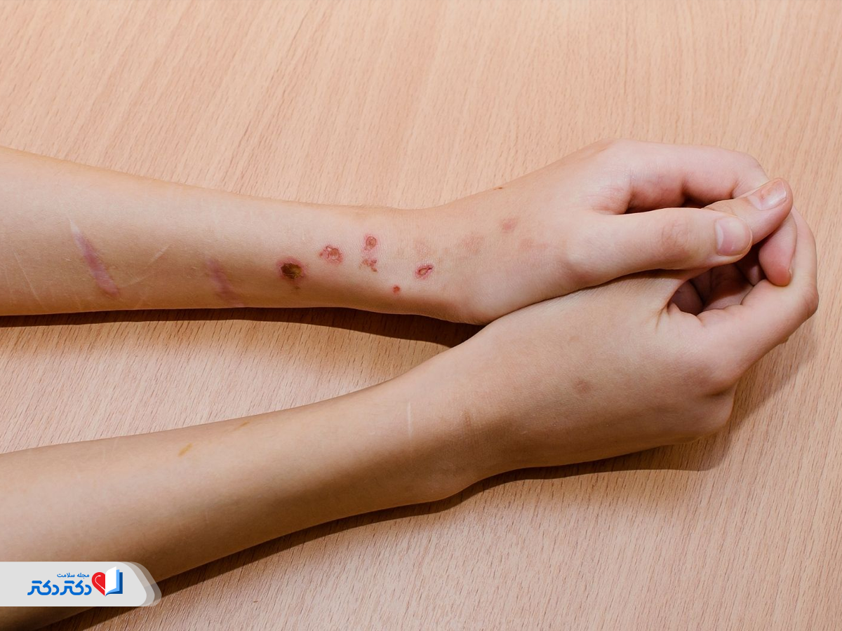 افکار مرگ یا خودکشی از علائم افسردگی سایکوتیک