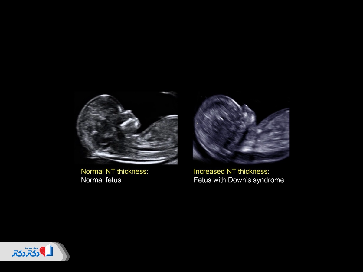 عکس سونوگرافی NT عادی و غیرطبیعی